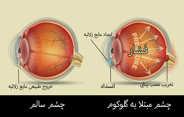 گلوکوم