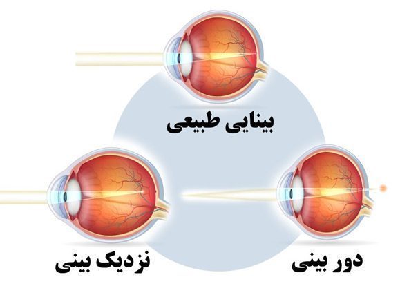 بیماری های چشم