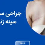 جراحی سرطان سینه زنان