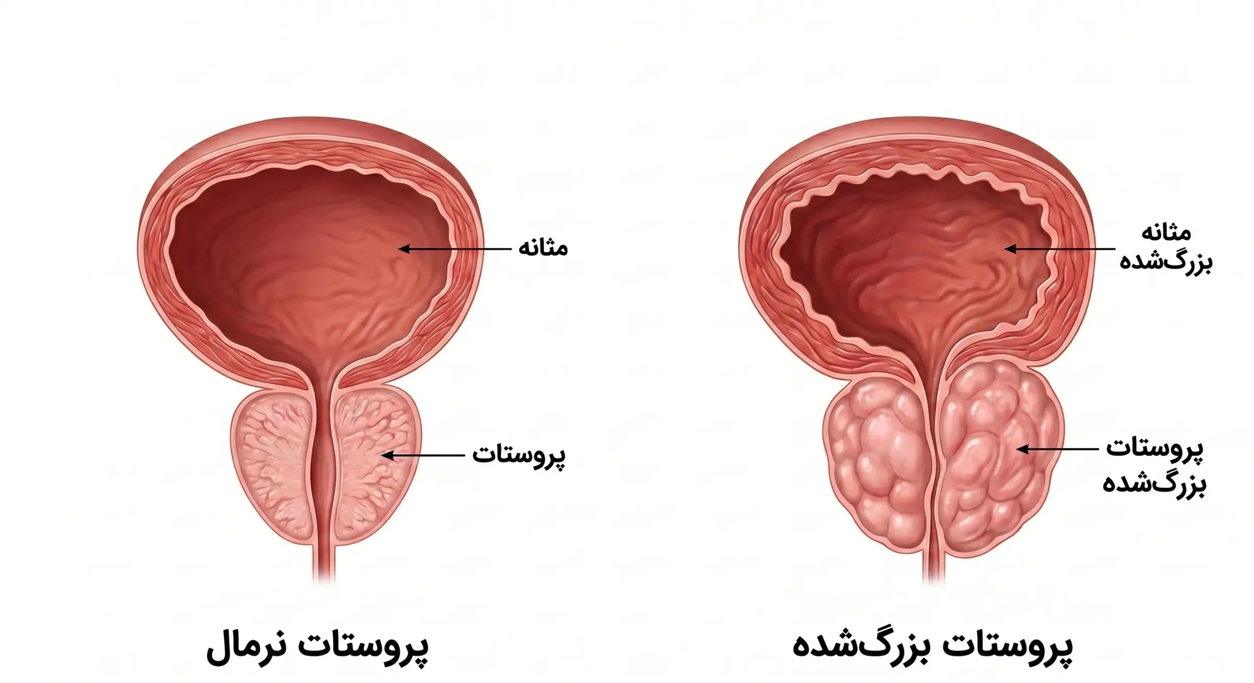 عکس پروستات مردان - مقایسه پروستات نرمال با پروستات بزرگ شده