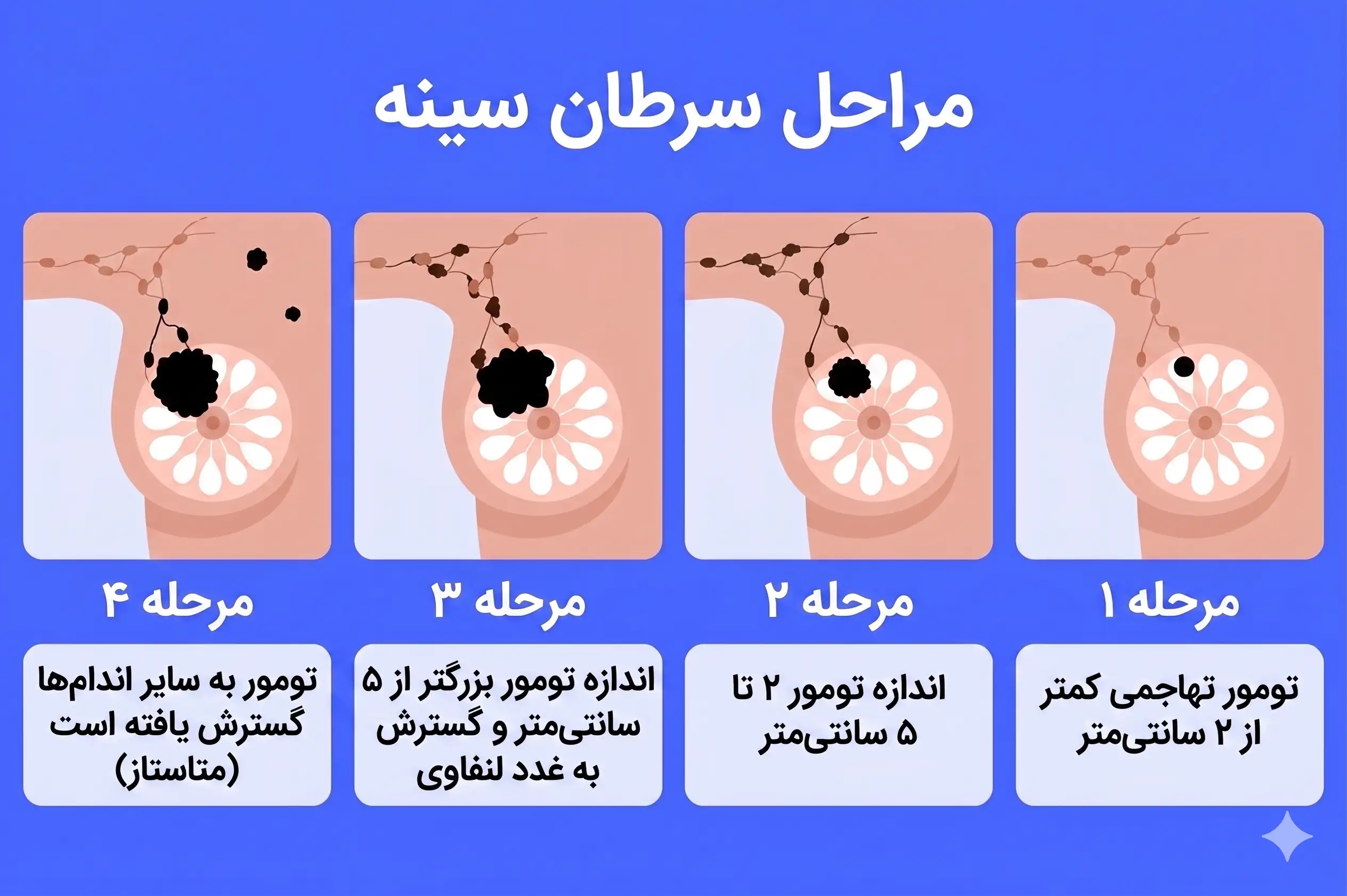 مراحل سرطان سینه